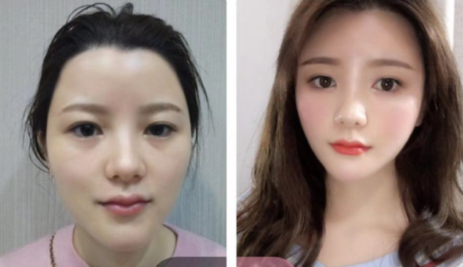 王世虎自体脂肪填充案例