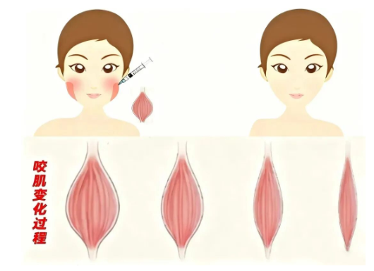 面部脂肪多的人适合打瘦脸针吗