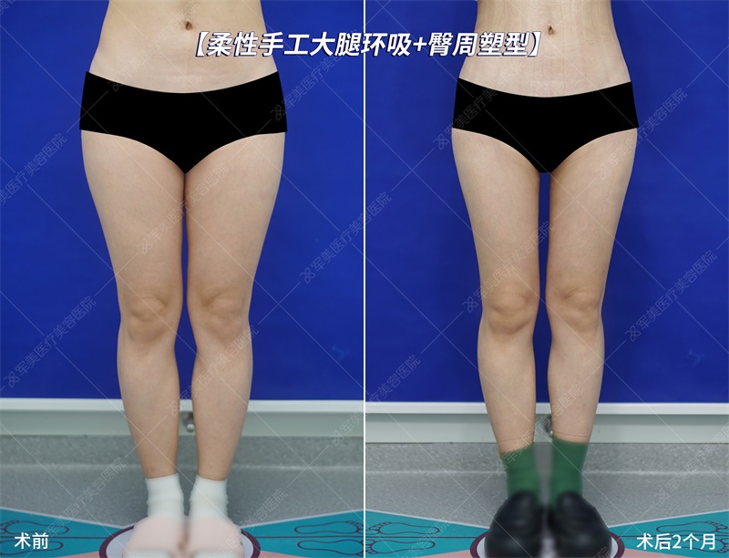 妈妈臀抽脂前后对比