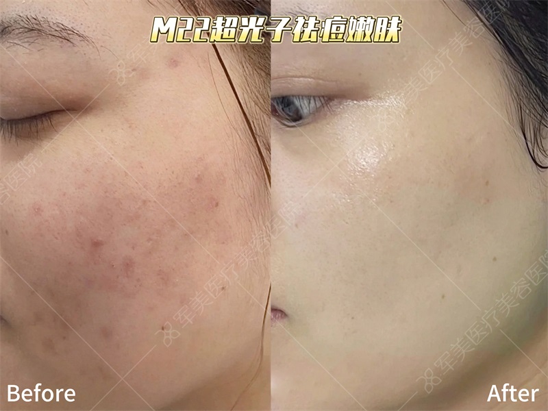 M22超光子祛痘嫩肤