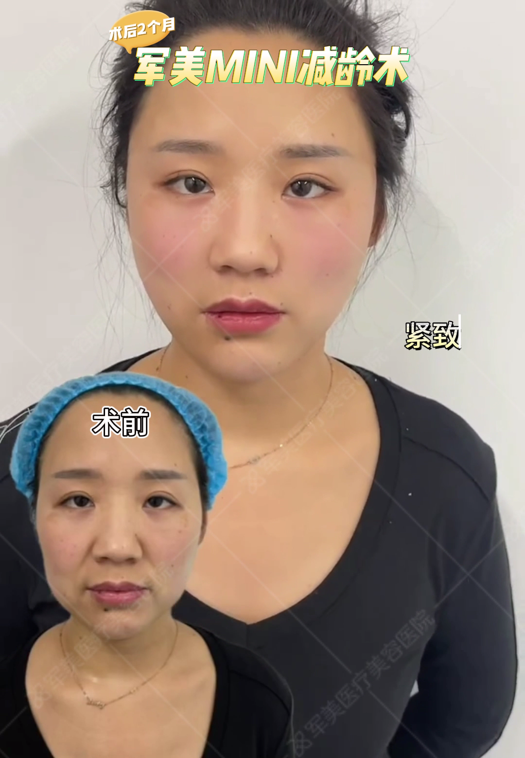 面部抗衰老做什么项目