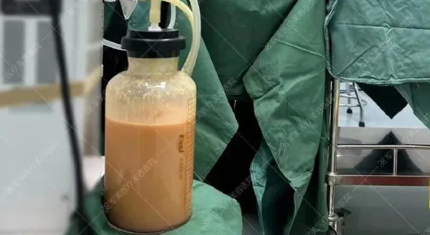 5g天使光雕吸脂怎么样