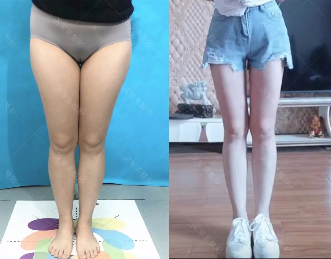 大腿吸脂真实案例对比