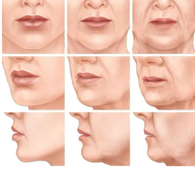 口周老化怎么改善