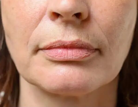 口周老化做什么项目