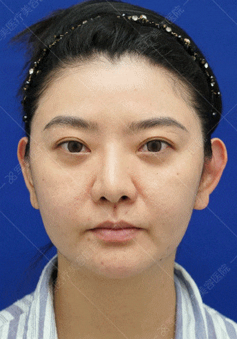 大饼脸改善案例