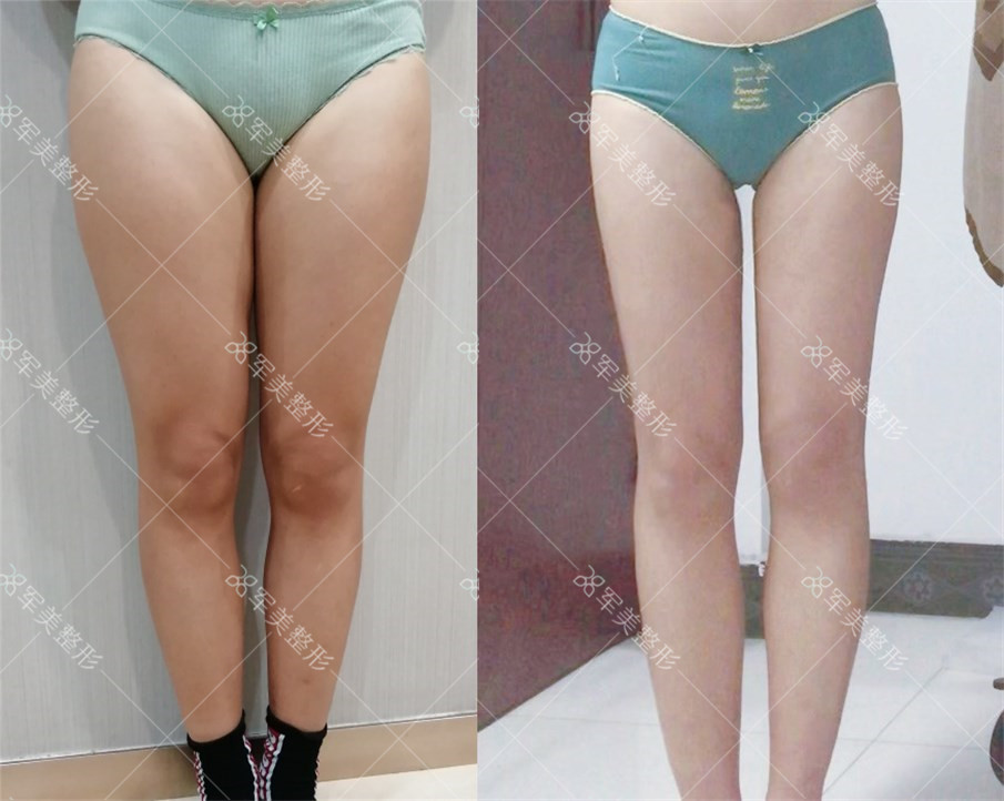 吸脂手术哪个医院最好