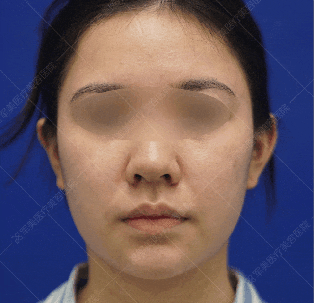 面部脂肪填充馒化怎么修复