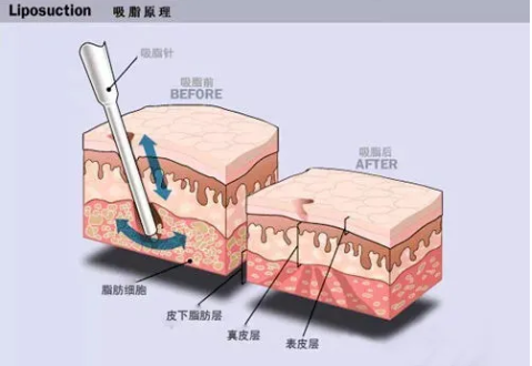 腰腹部赘肉怎么减原理