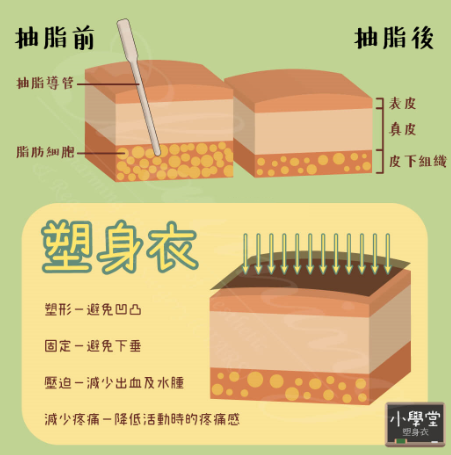 吸脂后塑身衣要穿多久