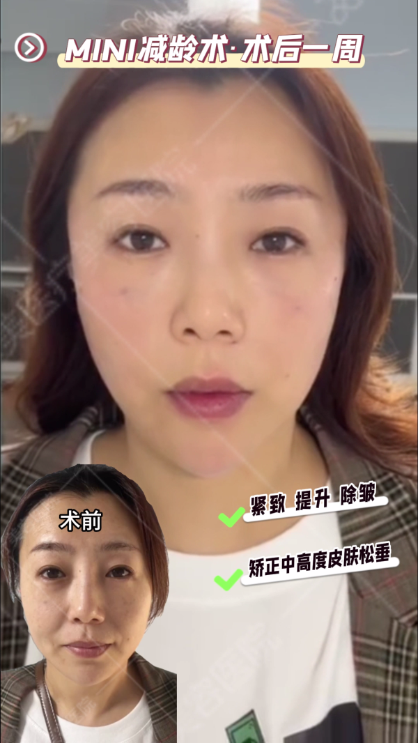 面部抗衰老年轻化