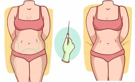 抽脂的最佳季节