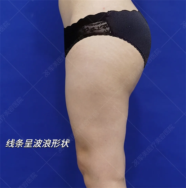 腿部凹凸不平修复案例