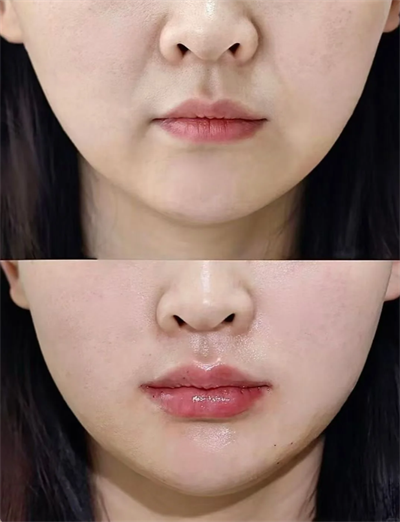 木偶纹改善案例