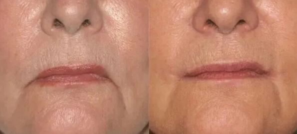 木偶纹怎么改善