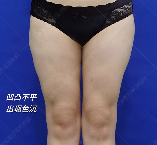 大腿吸脂修复前后对比图