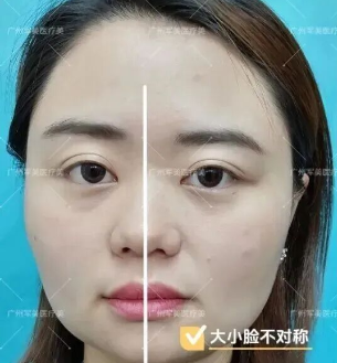 面部吸脂多久恢复