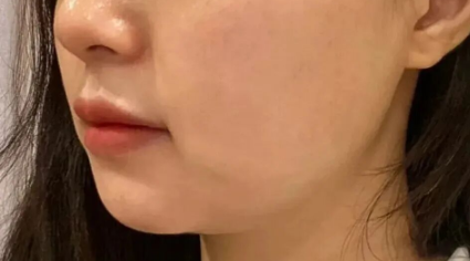 如何判断自己是否适合面部吸脂