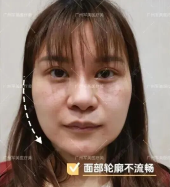 面部吸脂后面罩带多久