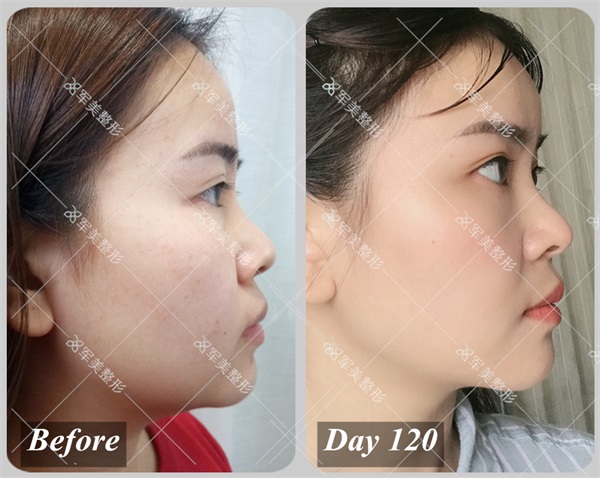 双下巴吸脂案例