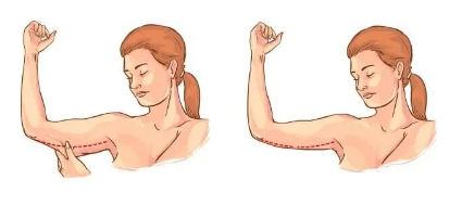 手臂粗壮怎么减最快瘦下来