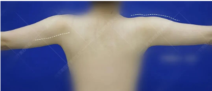 吸脂瘦手臂效果图