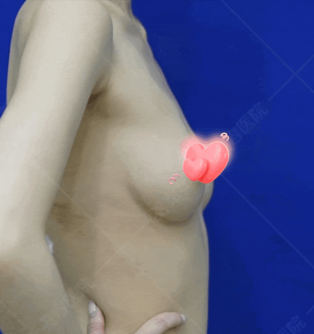 自体脂肪丰胸案例