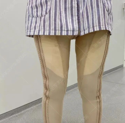 吸脂后皮肤会变松弛吗