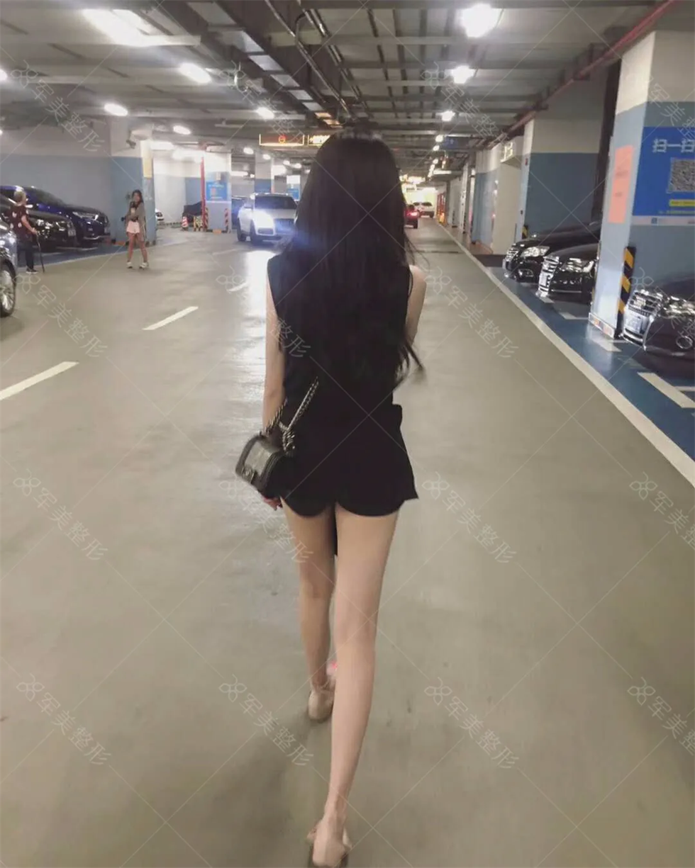 王世虎大腿吸脂案例