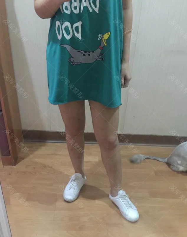 王世虎吸脂案例