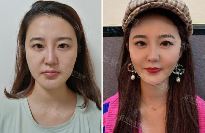 面部衰老怎么改善