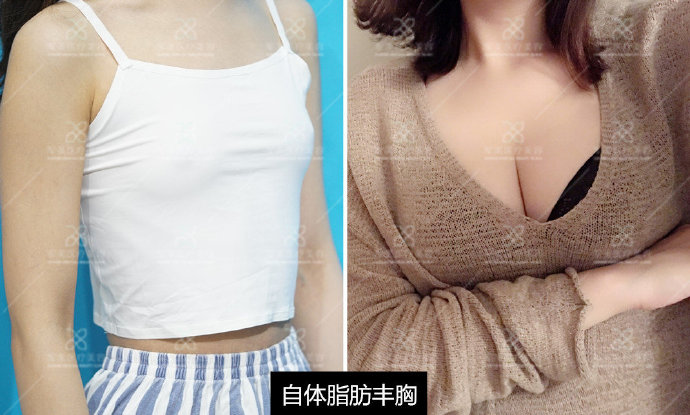 王世虎脂肪丰胸