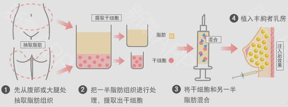 脂肪丰胸效果如何