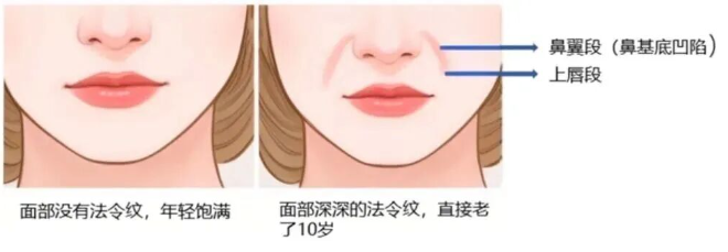 法令纹怎么改善消除