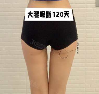 吸脂会不会留疤