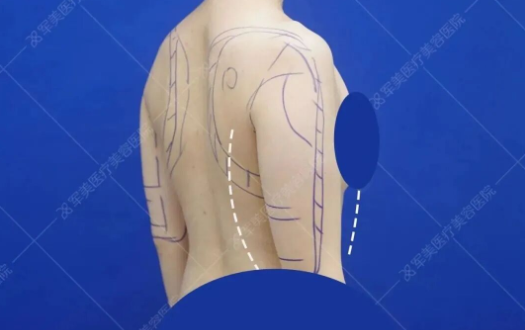 手臂粗壮怎么减最快瘦下来