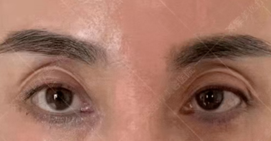 自体脂肪填充面部凹陷案例