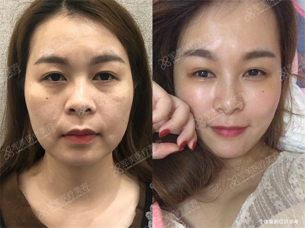 自体脂肪填充面部凹陷案例