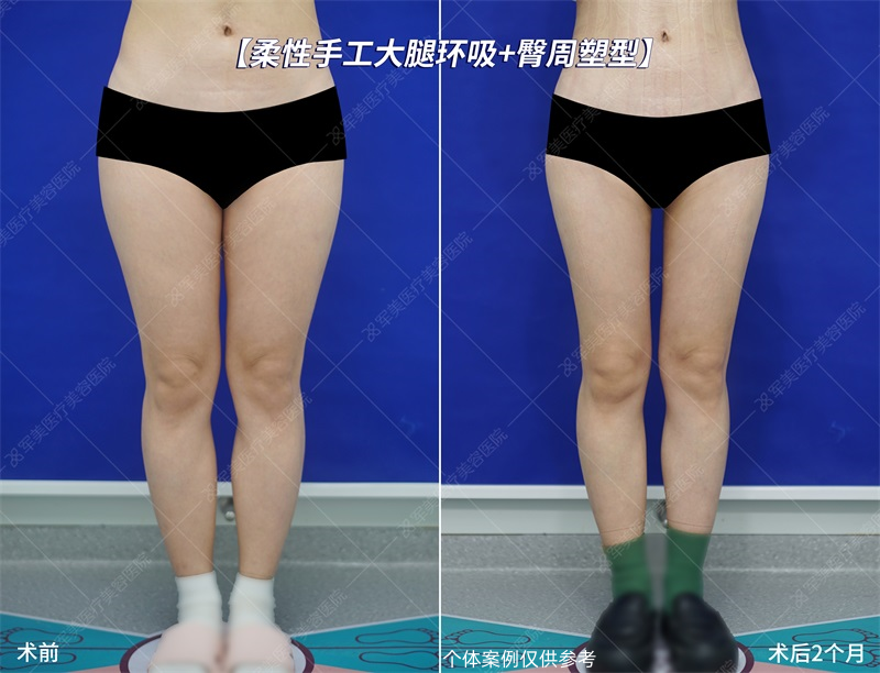 妈妈臀吸脂改善案例