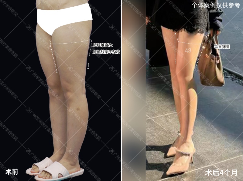 吸脂会不会凹凸不平