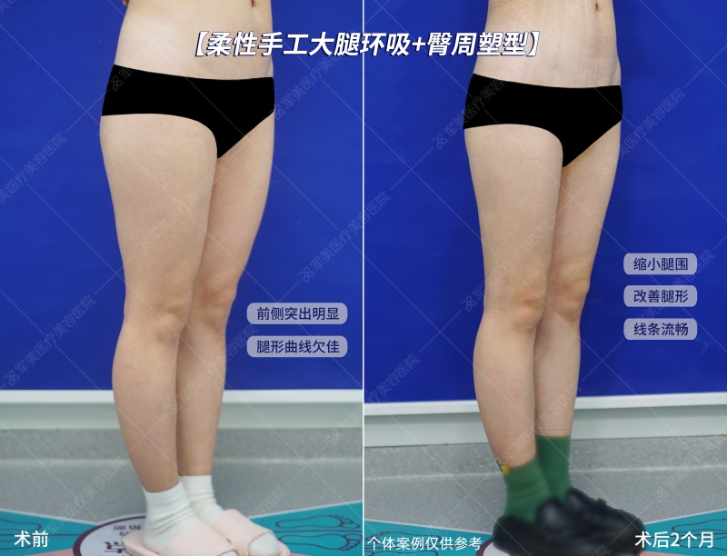 妈妈臀吸脂改善案例