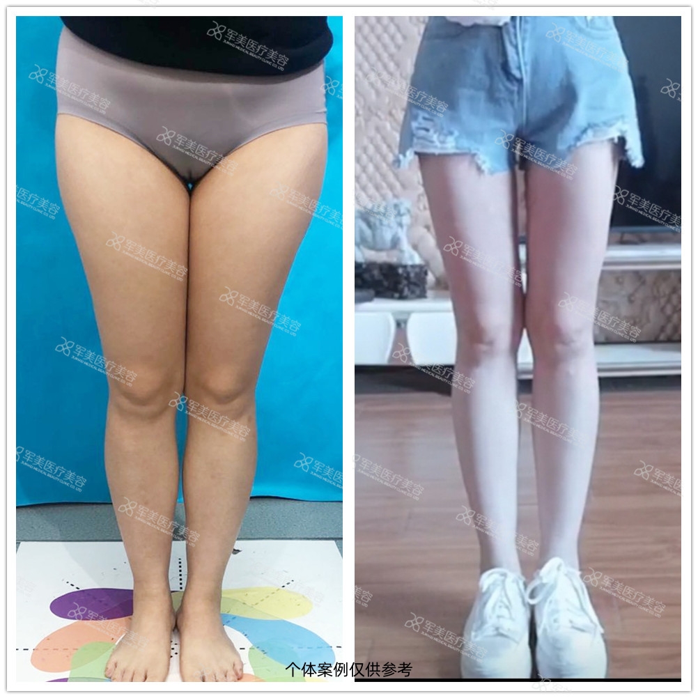 大腿吸脂减肥案例