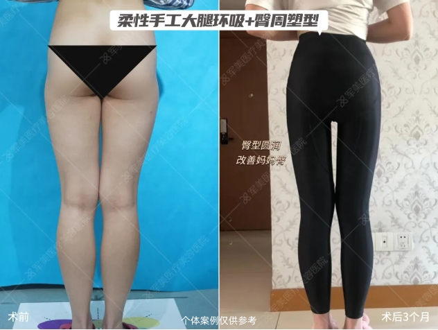 王世虎大腿吸脂案例
