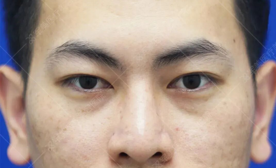 黑眼圈去掉最快最有效案例