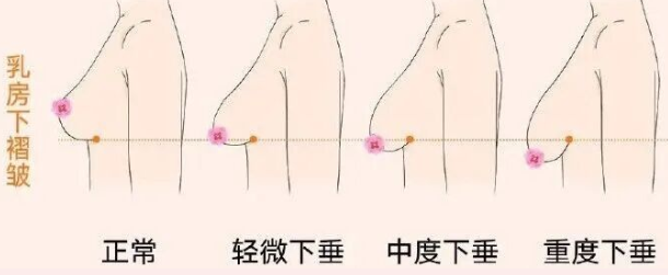 胸部下垂原理