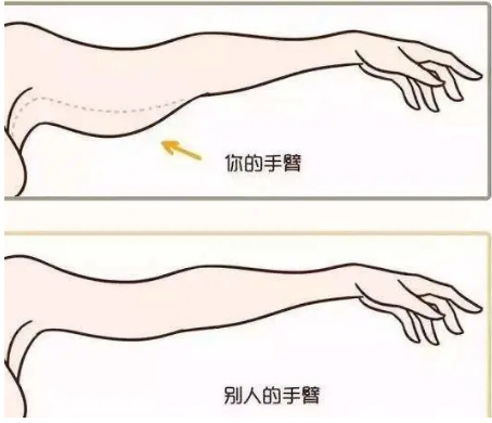 拜拜肉和蝴蝶臂怎么去除