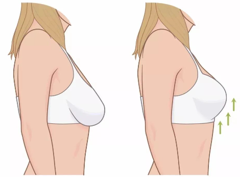 自体脂肪丰胸会影响哺乳吗