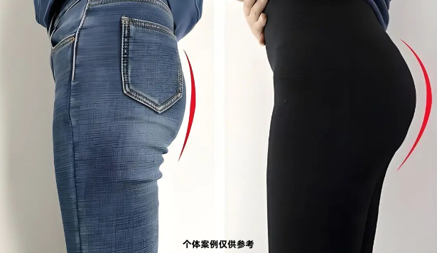 广州军美自体脂肪丰臀