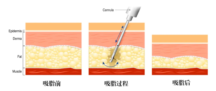 吸脂术前准备