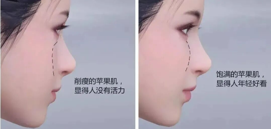 填充后的苹果肌